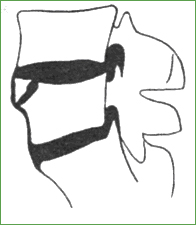 . Передняя грыжа Шморля, отслаивающая верхний угол тела позвонка 