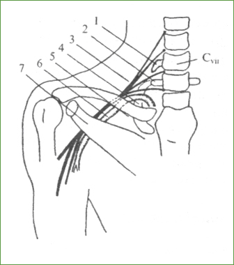 Синдромы сдавления нижнего первичного - внутреннего вторичного пучков плечевого сплетения