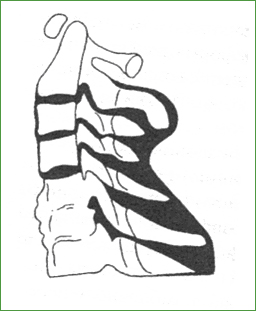 Болезнь Педжета с поражением нижних шейных позвонков. Клинически - хроническая боль в шее, цервикальная миелопатия 
